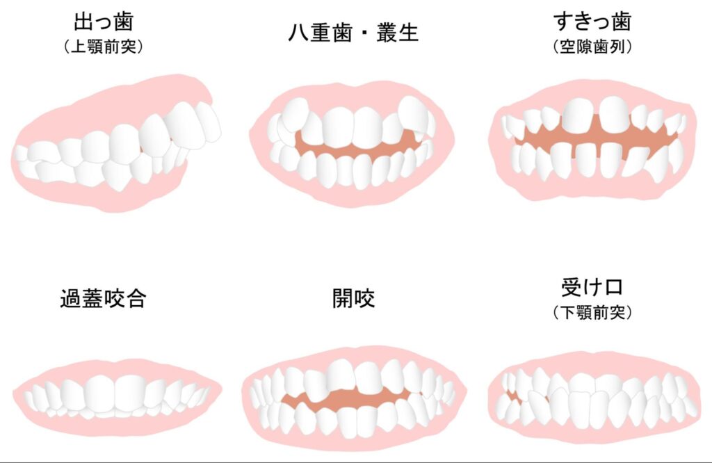 歯並び 悪くなる原因