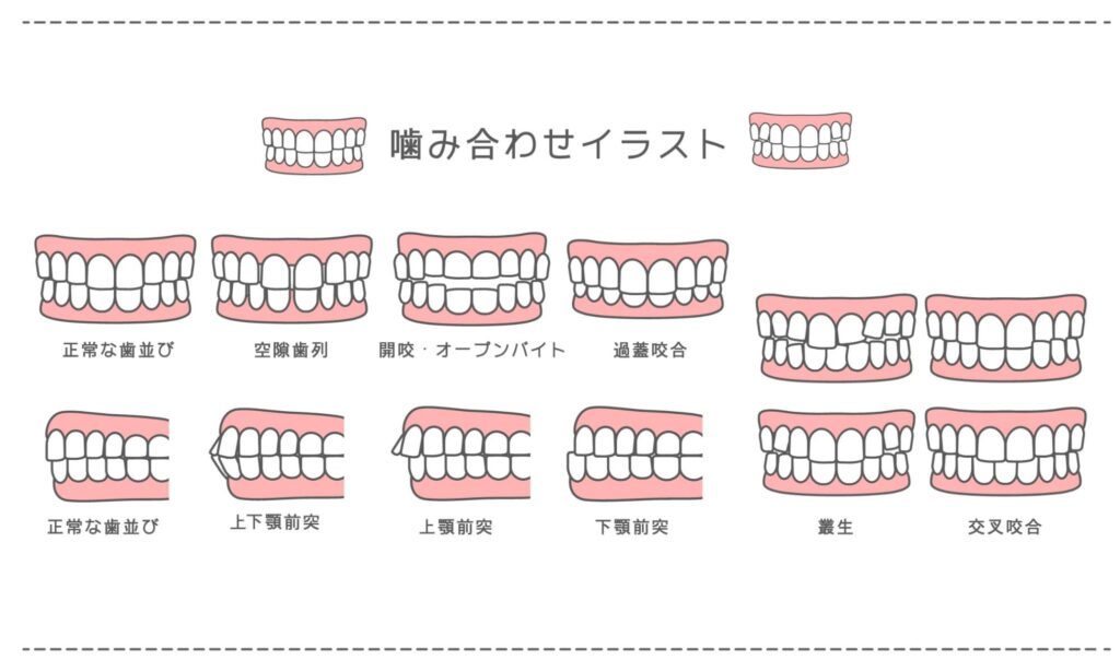 マウスピース矯正 期間