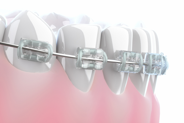 マウスピース矯正 ワイヤー矯正